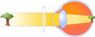 hyperopia_corrected.jpg