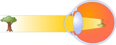 A myopic eye myopia.jpg