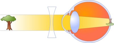 A corrected myopic eye myopia_corrected.jpg